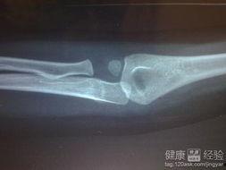 骨折可以吃茭瓜吗